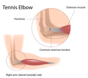 Tennis Elbow Lateral Epicondylitis Wayne Paramus Nj