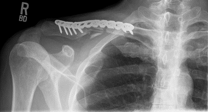 Clavicle ORIF (Open Reduction and Internal Fixation)
