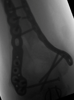 Distal Humerus ORIF (Open Reduction Internal Fixation) Olecranon ORIF (Open Reduction Internal Fixation)Modern Orthopaedics of New Jersey, Wayne, Parsippany, Dr. Peter DeNoble MD and Dr. David Ratliff MD. Orthopedic Surgeons, Hand Surgeon