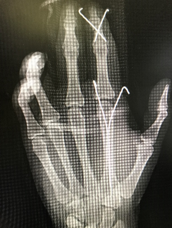 Metacarpal CRPP (Closed Reduction and Percutaneous Pinning), Phalanx CRPP