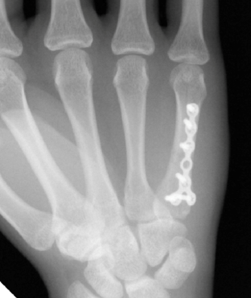 Phalanx ORIF, Metacarpal (ORIF) Open Reduction Internal Fixation