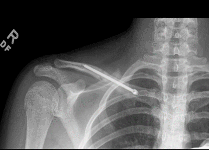 Clavicle ORIF (Open Reduction and Internal Fixation)