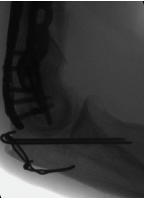 Distal Humerus ORIF (Open Reduction Internal Fixation)