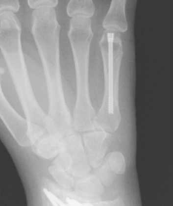 Metacarpal (ORIF) Open Reduction Internal Fixation