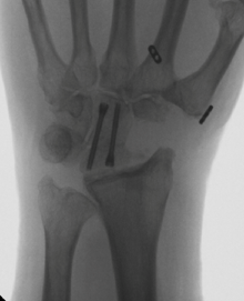Four Corner Fusion Modern Orthopaedics of New Jersey, Wayne, Parsippany, Dr. Peter DeNoble MD and Dr. David Ratliff MD. Orthopedic Surgeons, Hand Surgeon