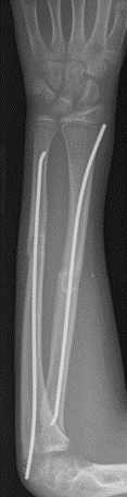 Both bone forearm Open Reduction Internal Fixation (ORIF)