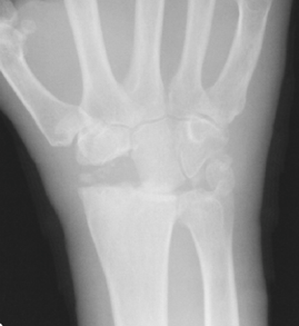 Proximal Row Carpectomy Modern Orthopaedics of New Jersey, Wayne, Parsippany, Dr. Peter DeNoble MD and Dr. David Ratliff MD. Orthopedic Surgeons, Hand Surgeon