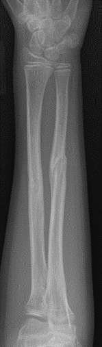 Both bone forearm Open Reduction Internal Fixation (ORIF)
