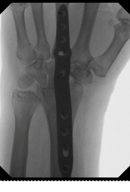 Total or Partial Wrist Fusion Modern Orthopaedics of New Jersey, Wayne, Parsippany, Dr. Peter DeNoble MD and Dr. David Ratliff MD. Orthopedic Surgeons, Hand Surgeon
