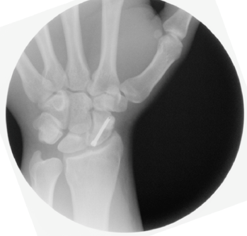 Scaphoid Fracture Open Reduction Internal Fixation (ORIF)