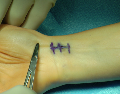 Ganglion Cyst Excision - Modern Orthopaedics of New Jersey, Wayne, Parsippany, Dr. Peter DeNoble MD and Dr. David Ratliff MD. Orthopedic Surgeons, Hand Surgeon
