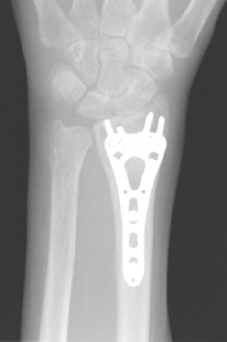 Distal Radius ORIF (Open Reduction Internal Fixation) Modern Orthopaedics of New Jersey, Wayne, Parsippany, Dr. Peter DeNoble MD and Dr. David Ratliff MD. Orthopedic Surgeons, Hand Surgeon