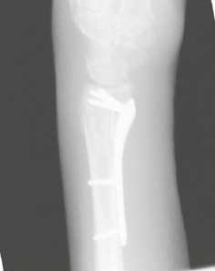 Distal Radius ORIF (Open Reduction Internal Fixation) -Modern Orthopaedics of New Jersey, Wayne, Parsippany, Dr. Peter DeNoble MD and Dr. David Ratliff MD. Orthopedic Surgeons, Hand Surgeon