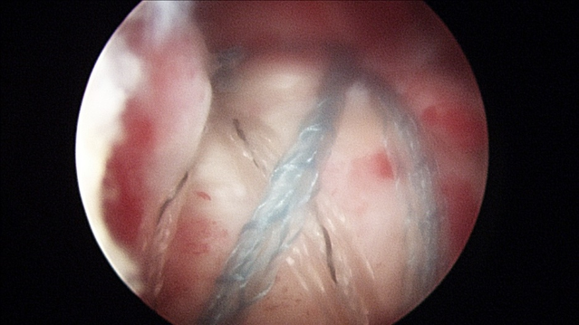 Arthroscopic Rotator Cuff Repair