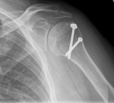 Proximal Humerus ORIF (Open Reduction Internal Fixation)