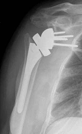 Reverse Total Shoulder Arthroplasty