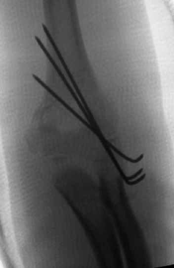 Scaphoid Fracture Open Reduction Internal Fixation (ORIF)