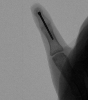 Interphalangeal Joint Fusion
