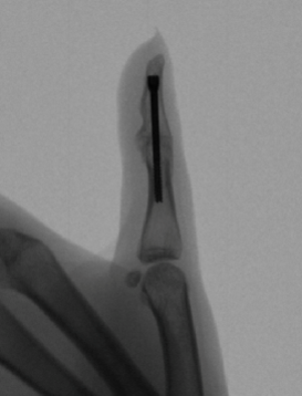 Interphalangeal Joint Fusion
