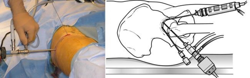 Hip Arthroscopy