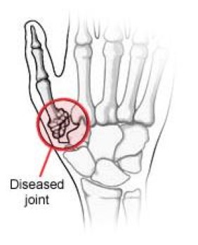 Basal Joint Arthritis