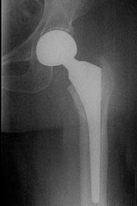 Hip Hemiarthroplasty
