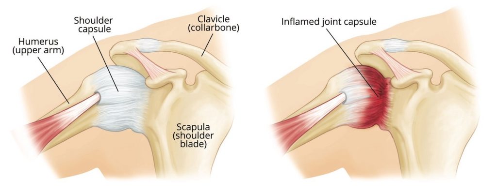 Adhesive Capsulitis (Frozen Shoulder)
