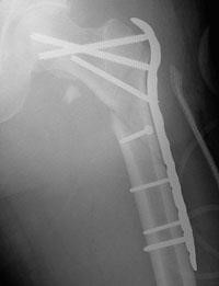 Intramedullary Nail vs. Plate and Screws