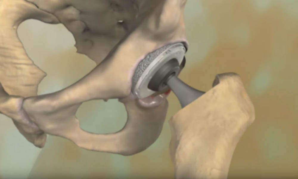Total Hip Arthroplasty
