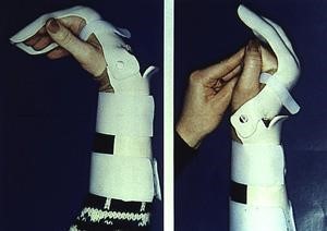 Flexor Tendon Repair