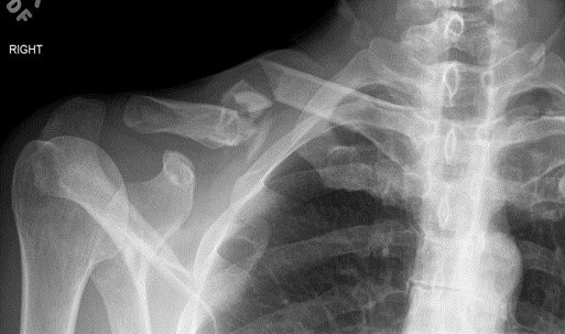 Clavicle Fracture (Collar Bone Fracture)