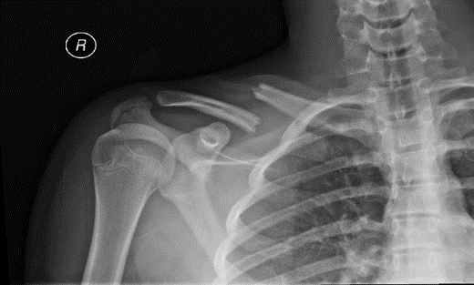Clavicle Fracture (Collar Bone Fracture)