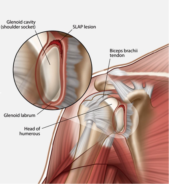 Labral Tear