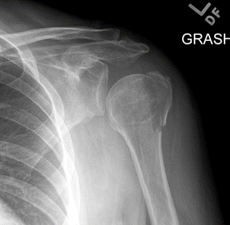 Proximal Humerus Fracture