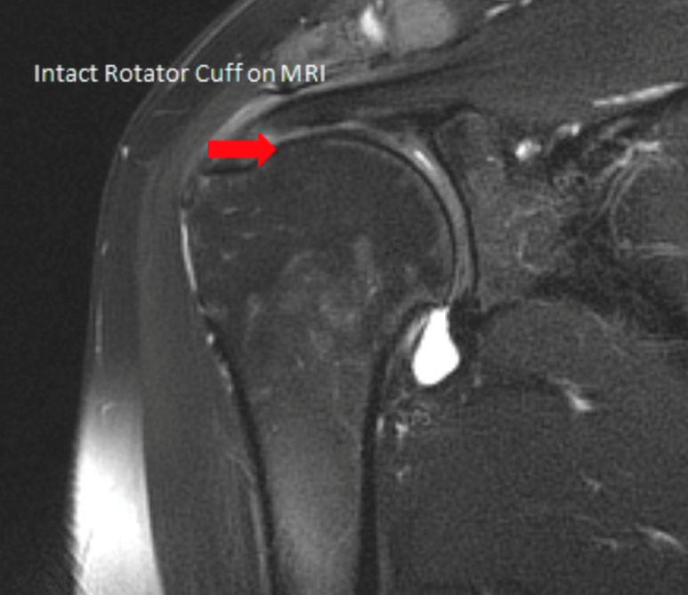 Rotator Cuff Tear