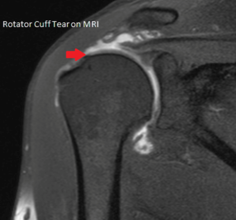 Rotator Cuff Tear