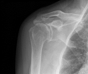 Shoulder Arthritis