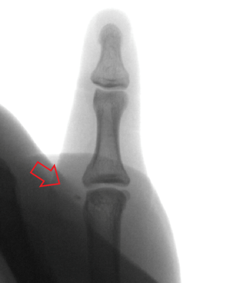 UCL and RCL Repair, UCL and RCL Rupture
