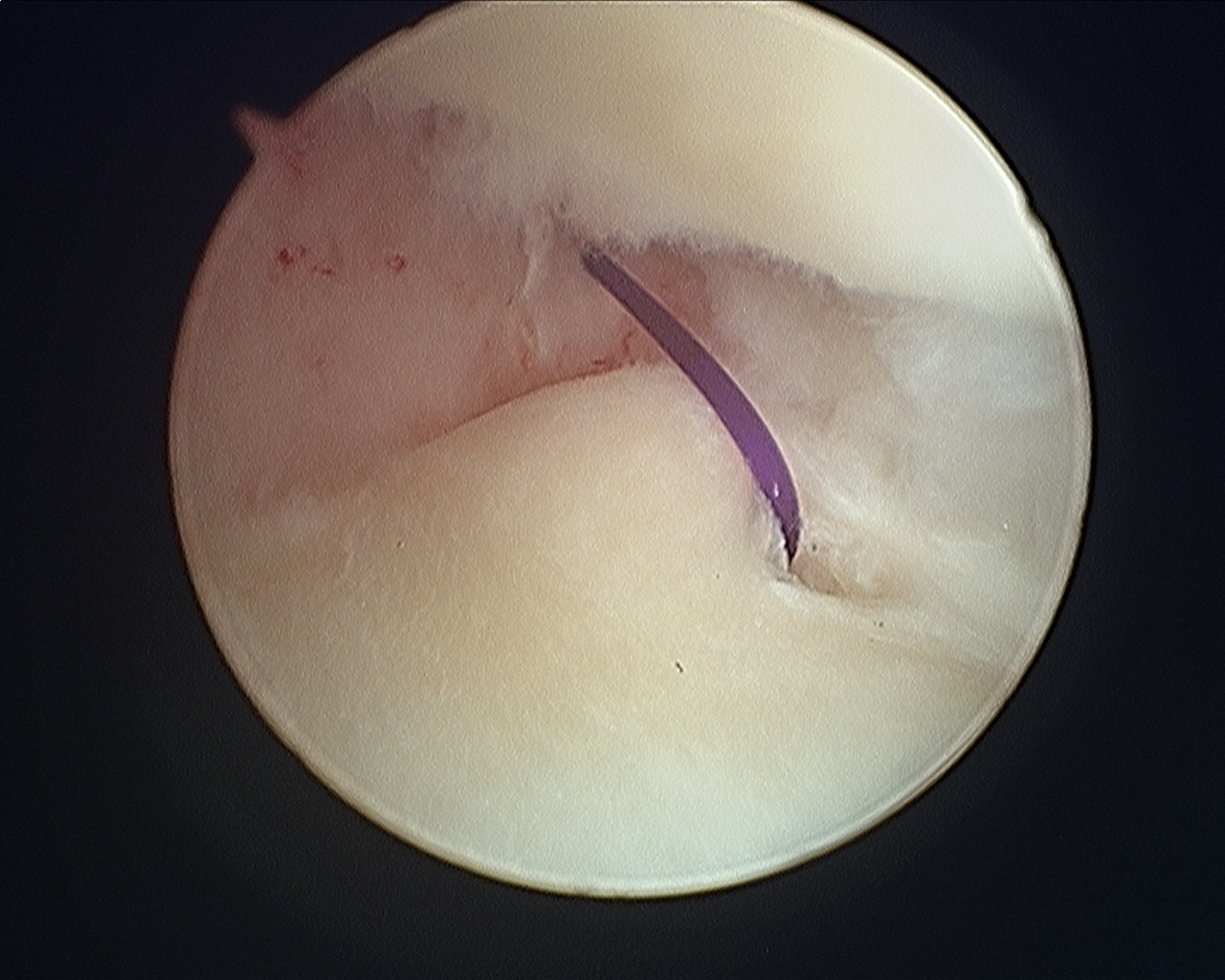 Arthroscopic TFCC Repair