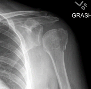 Proximal humerus fracture illustration