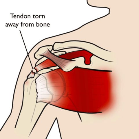 What Does A Torn Rotator Cuff Feel Like? - Modern Orthopedics of New Jersey