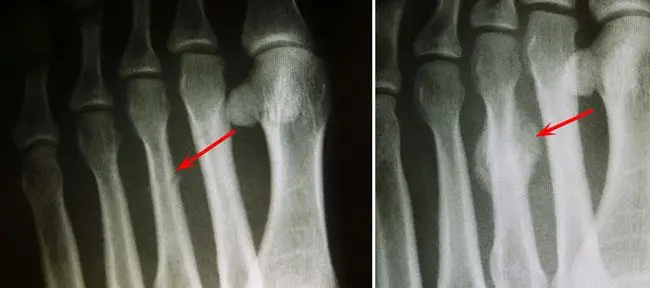 toe fracture x-rays