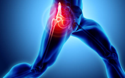 Signs You Need Hip Replacement Surgery