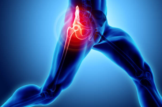 Signs You Need Hip Replacement Surgery