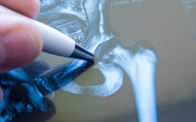 Is A Hip Replacement Major Surgery? What To Expect And How To Prepare