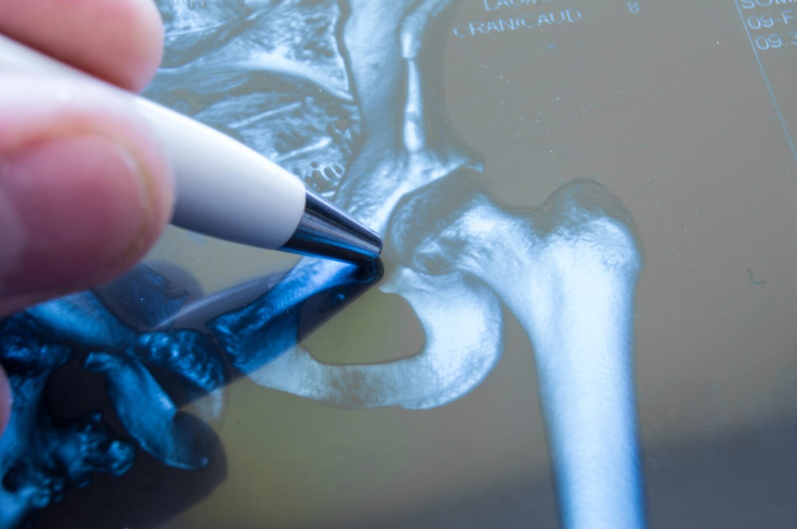 Is A Hip Replacement Major Surgery? What To Expect And How To Prepare